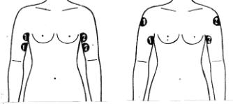 Миостимуляция мышц плеча